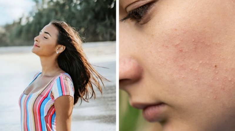 Rám nắng không làm sạch mụn (Ảnh: BrightSide) Rám nắng không làm sạch mụn (Ảnh: BrightSide)