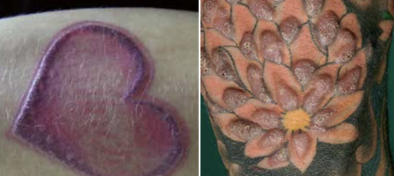 Các sần, mảng sần, sẹo lồi tồn tại dai dẳng do phản ứng dị ứng với mực xăm (Ảnh: BVCC)