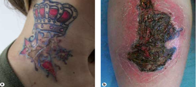 Nhiễm tụ cầu vàng và vi khuẩn sinh mủ sau khi xăm hình (Ảnh: BVCC)