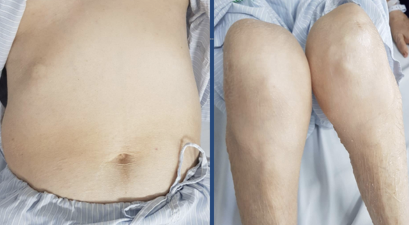 Một bệnh nhân bị teo cơ tứ chi, béo bụng, rạn da vùng bụng, da mỏng, dễ xuất huyết vì lạm dụng corticoid để trị đái tháo đường (Ảnh: BV Bạch Mai)