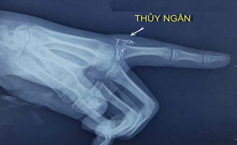 Ảnh chụp X-quang tay bé gái bị nhiễm độc thuỷ ngân (Ảnh BVCC)