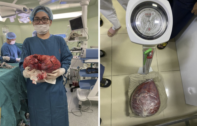 Khối u nặng 10kg của bệnh nhân (Ảnh - BVCC)