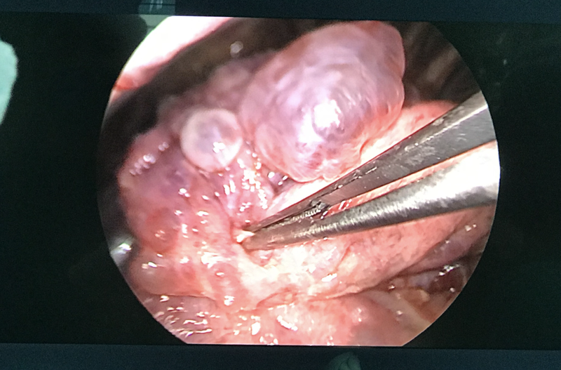 Kỹ thuật mổ nội soi đã cứu sống nhiều bệnh nhân nguy kịch (Ảnh - BVCC)