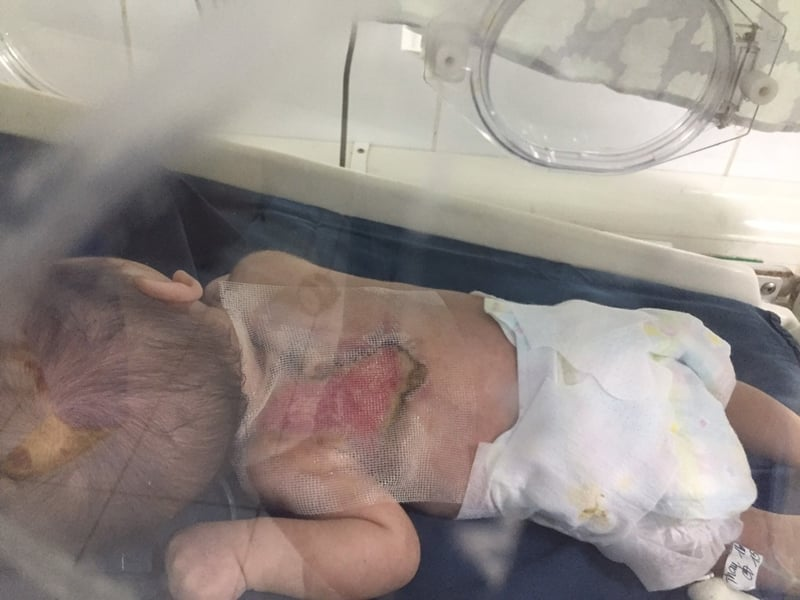 Bé sơ sinh bị hoại tử rộng vùng da lưng (Ảnh - BVCC)