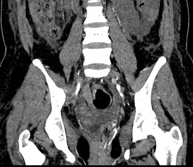 Hình ảnh thoát thuốc vị trí động mạch tử cung trái và quanh trực tràng của bệnh nhân (Ảnh - BVCC)