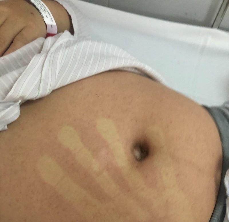 Hình ảnh ban đỏ ở bệnh nhân sốt xuất huyết (Ảnh - BVCC) Hình ảnh ban đỏ ở bệnh nhân sốt xuất huyết (Ảnh - BVCC)