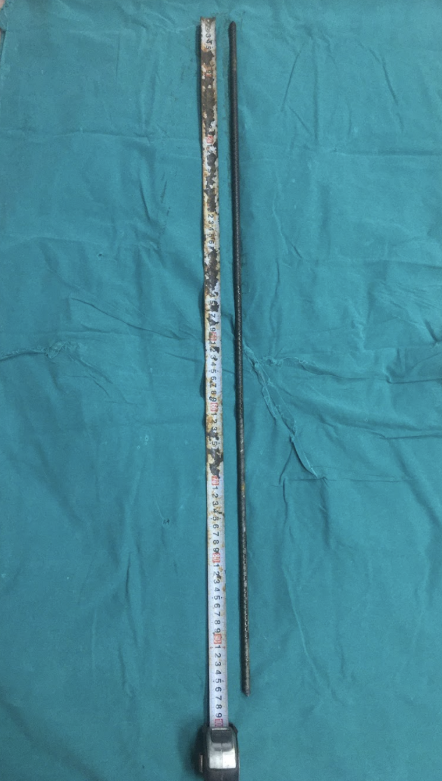 Thanh sắt đâm xuyên từ cổ qua não của bệnh nhân (Ảnh - BVCC)