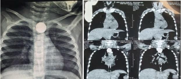 Hình ảnh chụp Xquang của bệnh nhi (Ảnh - BVCC)