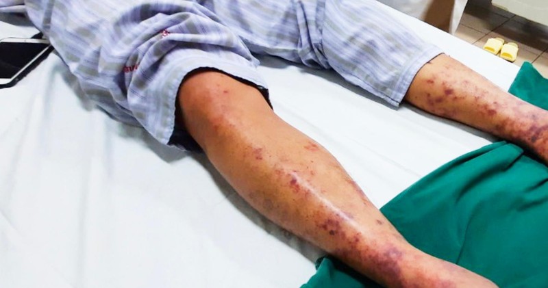 Hình ảnh da của bệnh nhân mắc liên cầu lợn (Ảnh - Đặng Thanh)