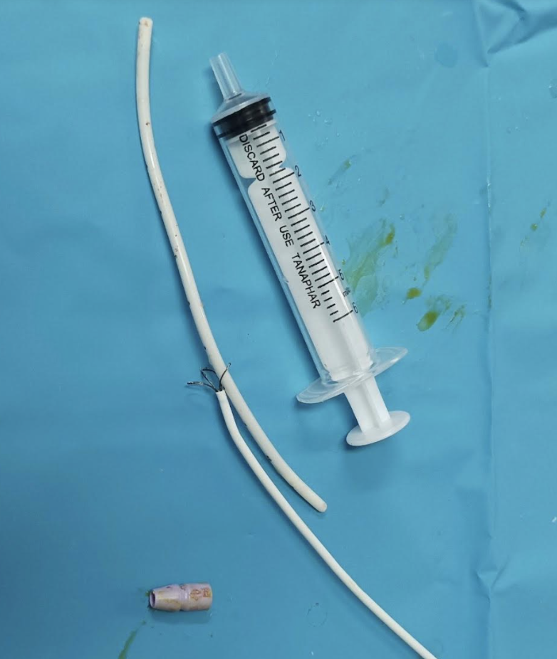 Hình ảnh dị vật kẹt trong tim bệnh nhân (Ảnh - BVCC)