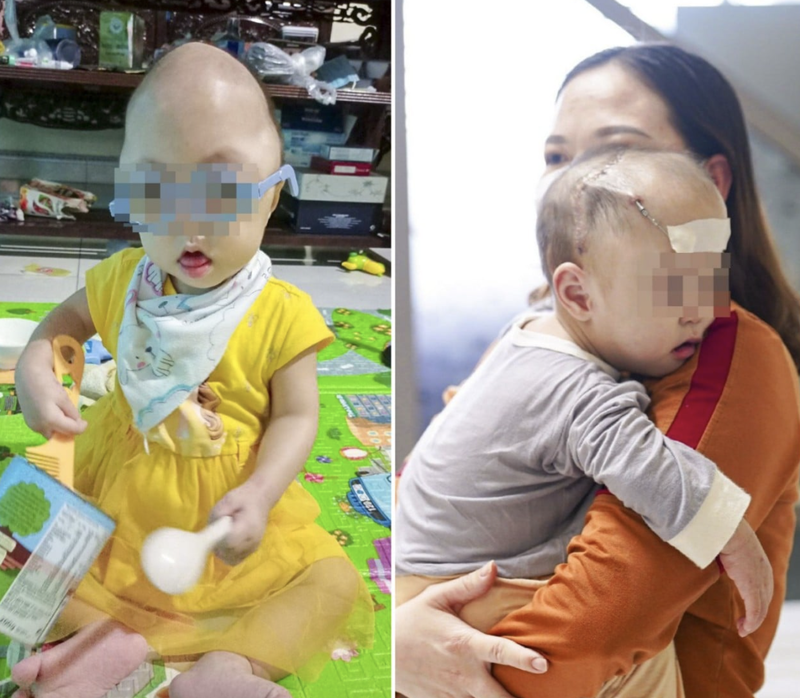 Bé M. trước và sau khi phẫu thuật (Ảnh - BVCC)