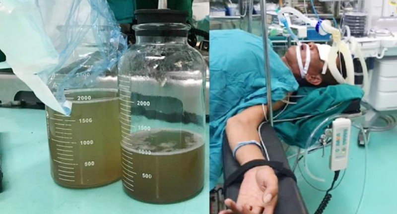 Dùng miệng hút dầu chạy máy xúc, bệnh nhân rơi vào tình trạng suy hô hấp, viêm phổi nặng