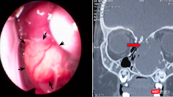 Mới 15 tháng tuổi, bé trai bị lồi mắt, nghẹt mũi vì khối u lớn chèn ép
