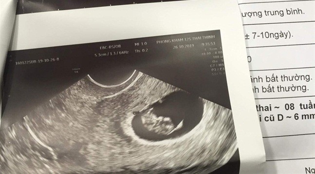Kết quả siêu âm cho thấy chị A. mang thai 8 tuần Kết quả siêu âm cho thấy chị A. mang thai 8 tuần