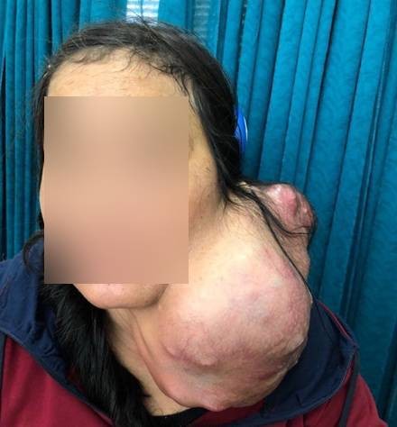 Bệnh nhân mang khối u trên cổ nặng 3kg. Ảnh: BVCC Bệnh nhân mang khối u trên cổ nặng 3kg. Ảnh: BVCC