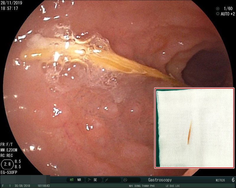 Hình ảnh nội soi cho thấy cây tăm rất mỏng, dài 5cm, nằm dọc và đã di chuyển đến tá tràng