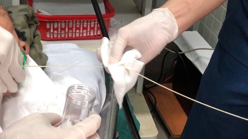 Kinh hãi con sán dây bò dài hơn 1m ký sinh trong tá tràng bệnh nhân