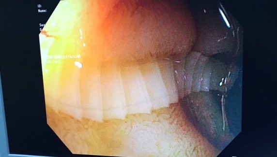 Hình ảnh nội soi con sán dây bò dài 1m sống trong tá tràng bệnh nhân. Ảnh: BVCC