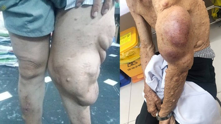 Cắt bỏ khối bướu sợi thần kinh khổng lồ khỏi cơ thể người đàn ông