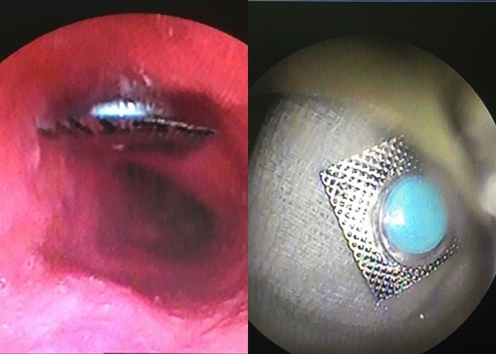 Hình ảnh nôi soi cho thấy viên thuốc còn nguyên vỏ trong bụng bệnh nhân. Ảnh: BV