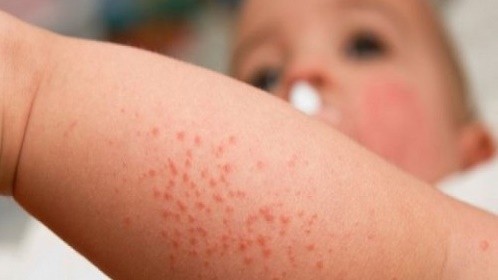 Bất ngờ bé trai 18 tháng tuổi bị sùi mào gà 