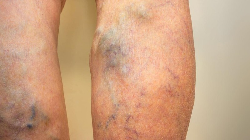 Kỹ thuật hiện đại giúp cứu sống bệnh nhân bị vỡ eo động mạch chủ ảnh 8 Đừng chủ quan với bệnh suy giãn tĩnh mạch