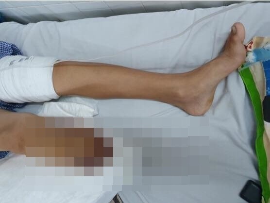 Hình ảnh chân bé trai sau khi đã phẫu thuật thành công. Ảnh: BSCC Hình ảnh chân bé trai sau khi đã phẫu thuật thành công. Ảnh: BSCC