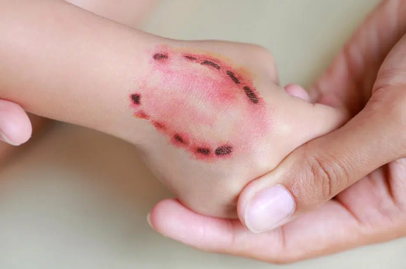 Bệnh dại tấn công cơ thể người thông qua các vết cắn của động vật có vú, máu nóng như chó, dơi, mèo,… Ảnh: Wikihow Bệnh dại tấn công cơ thể người thông qua các vết cắn của động vật có vú, máu nóng như chó, dơi, mèo,… Ảnh: Wikihow