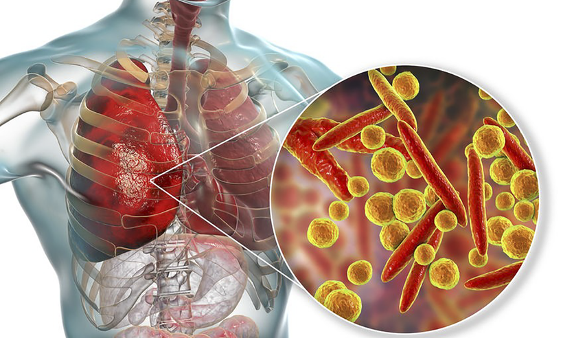 Virus Mycoplasma pneumoniae gây viêm phổi ở trẻ (ảnh BVCC)