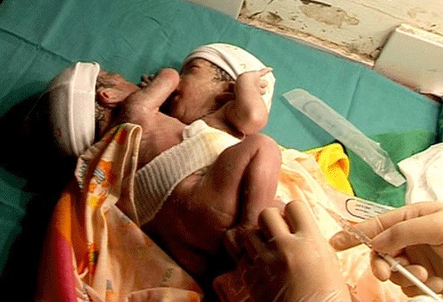 Cặp đôi song sinh ở Hà Giang 