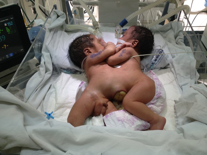 Cặp song sinh dính nhau ở Hà Giang năm 2016