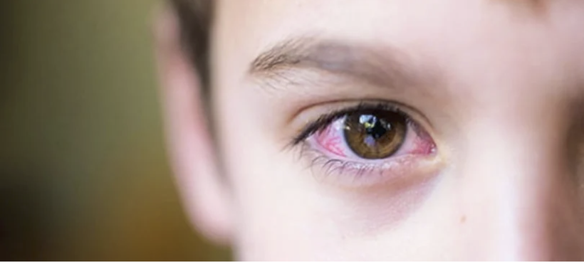 Dịch đau mắt đỏ đang bùng phát 