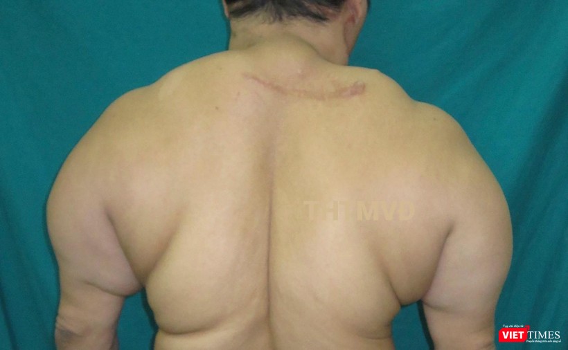 Một trường hợp mắc chứng u mỡ đối xứng hiếm gặp biểu hiện ở vùng gáy và vùng lưng. Một trường hợp mắc chứng u mỡ đối xứng hiếm gặp biểu hiện ở vùng gáy và vùng lưng.