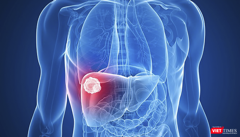 Ở Việt Nam, tử vong do ung thư gan gấp 3,8 lần tử vong do tai nạn giao thông (ảnh BVCC)