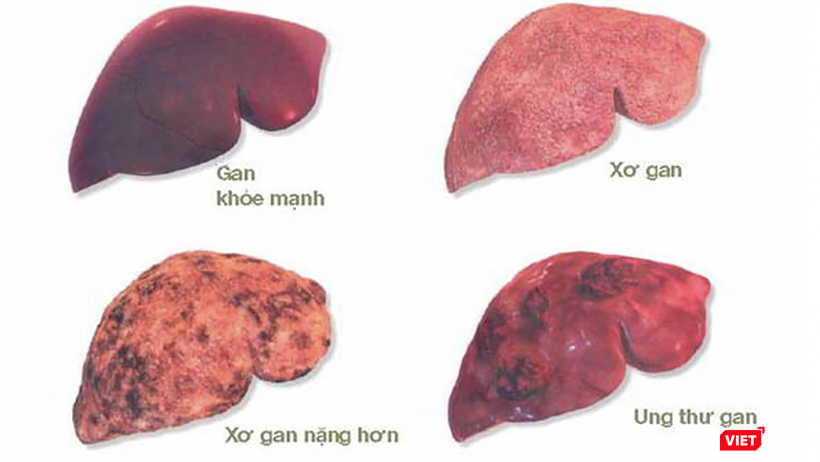 vt_ung thu gan 2.png