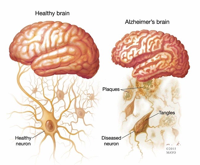 Đã tìm ra cách điều trị bệnh mất trí nhớ tạm thời Alzheimer’s ảnh 1 Đã tìm ra cách điều trị bệnh mất trí nhớ tạm thời Alzheimer’s ảnh 1