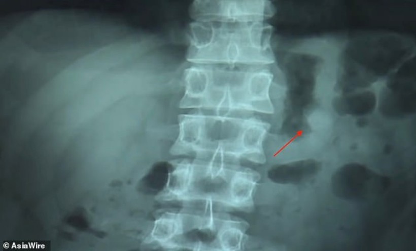 phim chụp X-quang cho thấy một bên tai nghe AirPods nằm trong cơ thể (ảnh: Asia Wire)