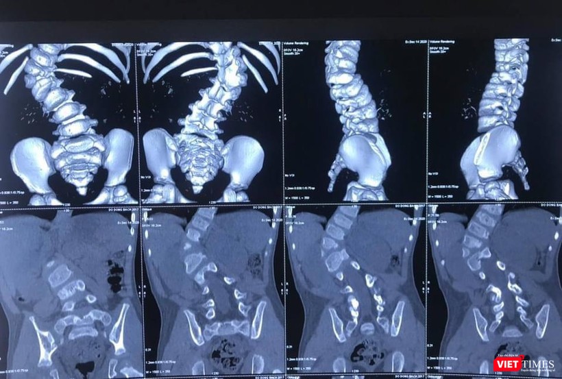 Hình ảnh X quang ca cong vẹo cột sống của bệnh nhi 3 tuổi (BVCC)