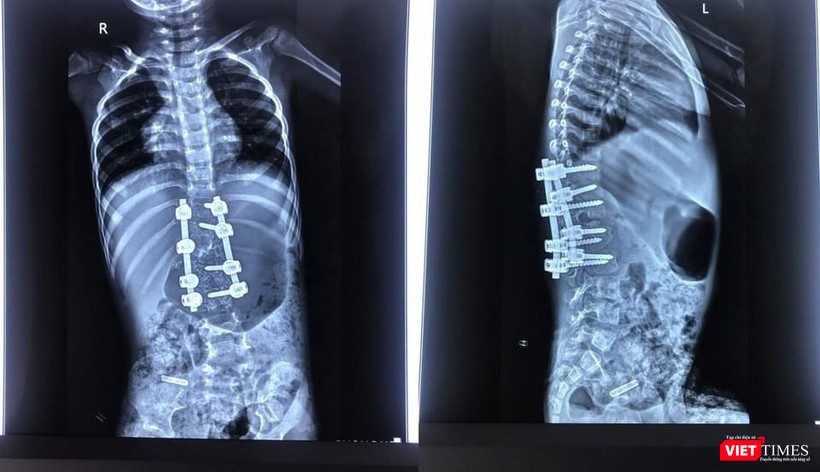 Bác sĩ cho biết sau phẫu thuật biến dạng được nắn chỉnh rất tốt