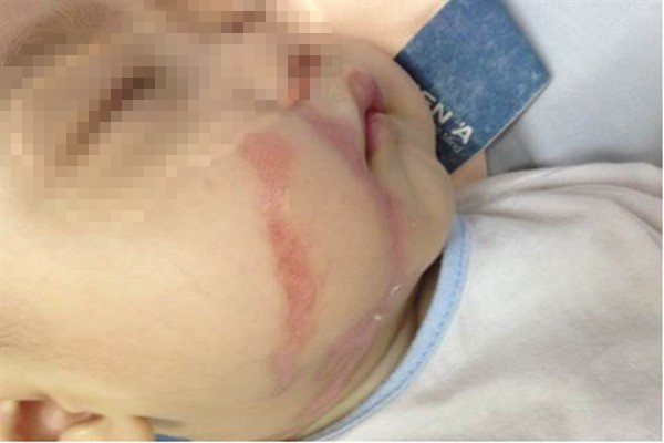 Trẻ nhỏ dễ bị bỏng vì hiếu động và tính tò mò