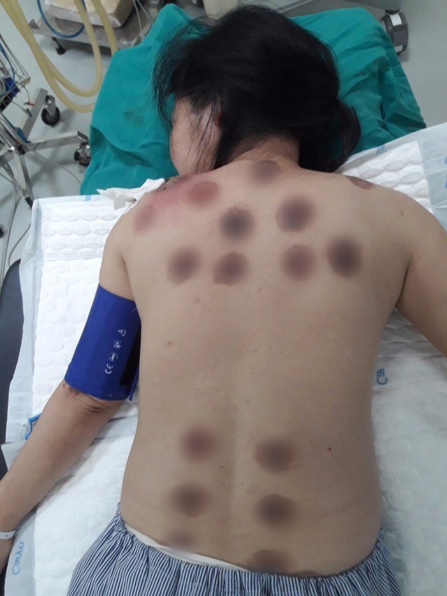 Tấm lưng bị bỏng, lở loét do liệu pháp giác hơi của bệnh nhân Th.