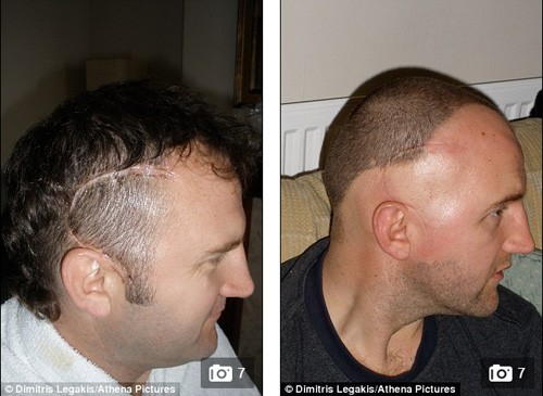 Bị ung thư não vì nghe điện thoại hơn 6 giờ mỗi ngày ảnh 3