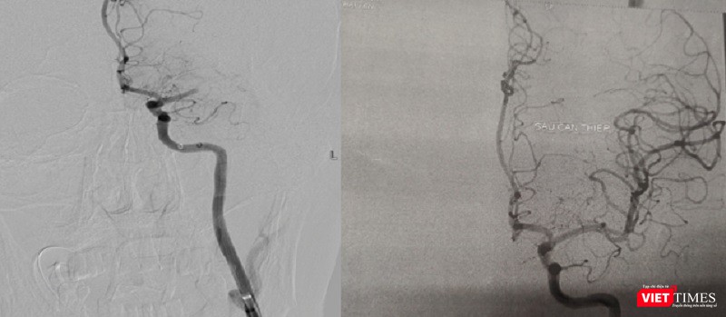 Hình ảnh động mạch não trước và sau khi hút huyết khối