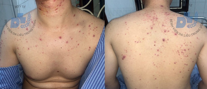 Sau hơn 1 tháng sử dụng thuốc nam, bệnh nhân xuất hiện thêm nhiều tổn thương sẩn mụn mủ kích thước đồng đều, rải rác vùng thân mình, cánh tay 2 bên. Sau hơn 1 tháng sử dụng thuốc nam, bệnh nhân xuất hiện thêm nhiều tổn thương sẩn mụn mủ kích thước đồng đều, rải rác vùng thân mình, cánh tay 2 bên.