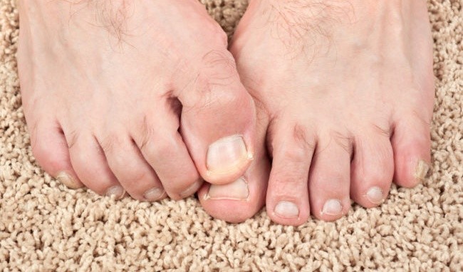 Người đàn ông 49 tuổi suýt mất chân vì tự ý đắp thuốc nam tại nhà