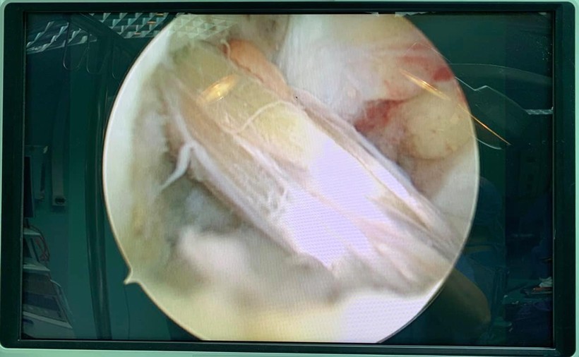 Dây chằng chéo trước ccủa bệnh nhân sau khi được tái tạo thành công. Ảnh: BVCC