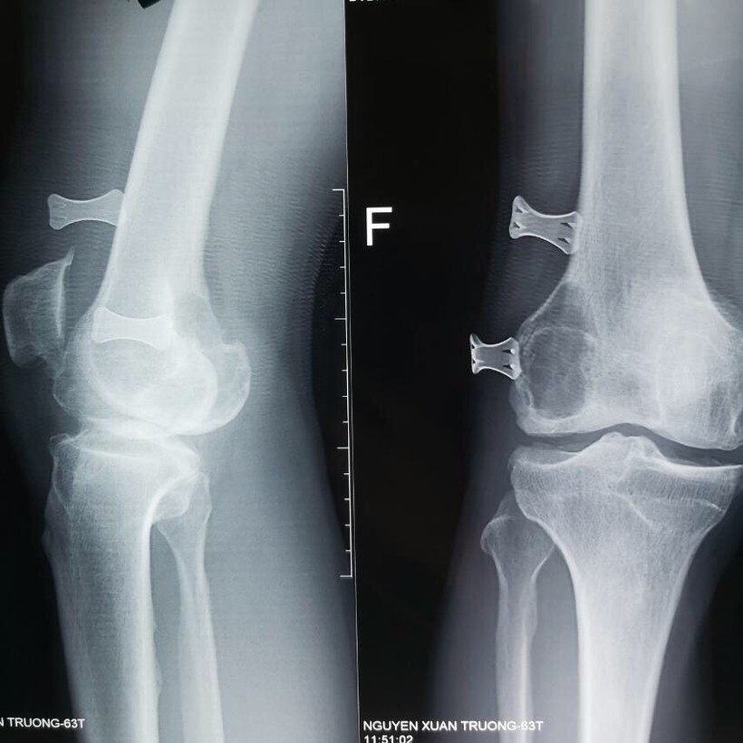 Phim chụp X-quang khớp gối của bệnh nhân (Ảnh: BVCC)