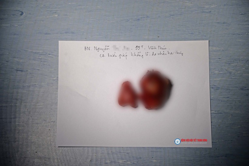 Khối u tuyến giáp khổng lồ của cụ bà 95 tuổi (Ảnh: Thúy Quỳnh)