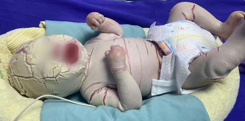 Bé trai sinh non 34 tuần bị mọc sừng khắp cơ thể (Ảnh: Bệnh viện Sản Nhi Quảng Ninh)