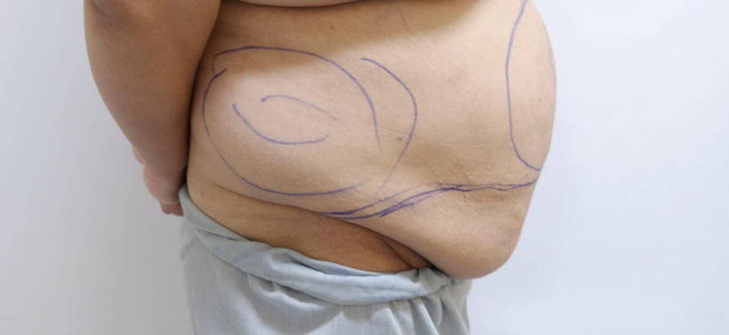 Mỡ bụng của chị H. trước khi phẫu thuật (Ảnh: BS. Nguyễn Đình Minh)